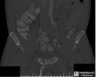 Pelvic Digit (Rib)